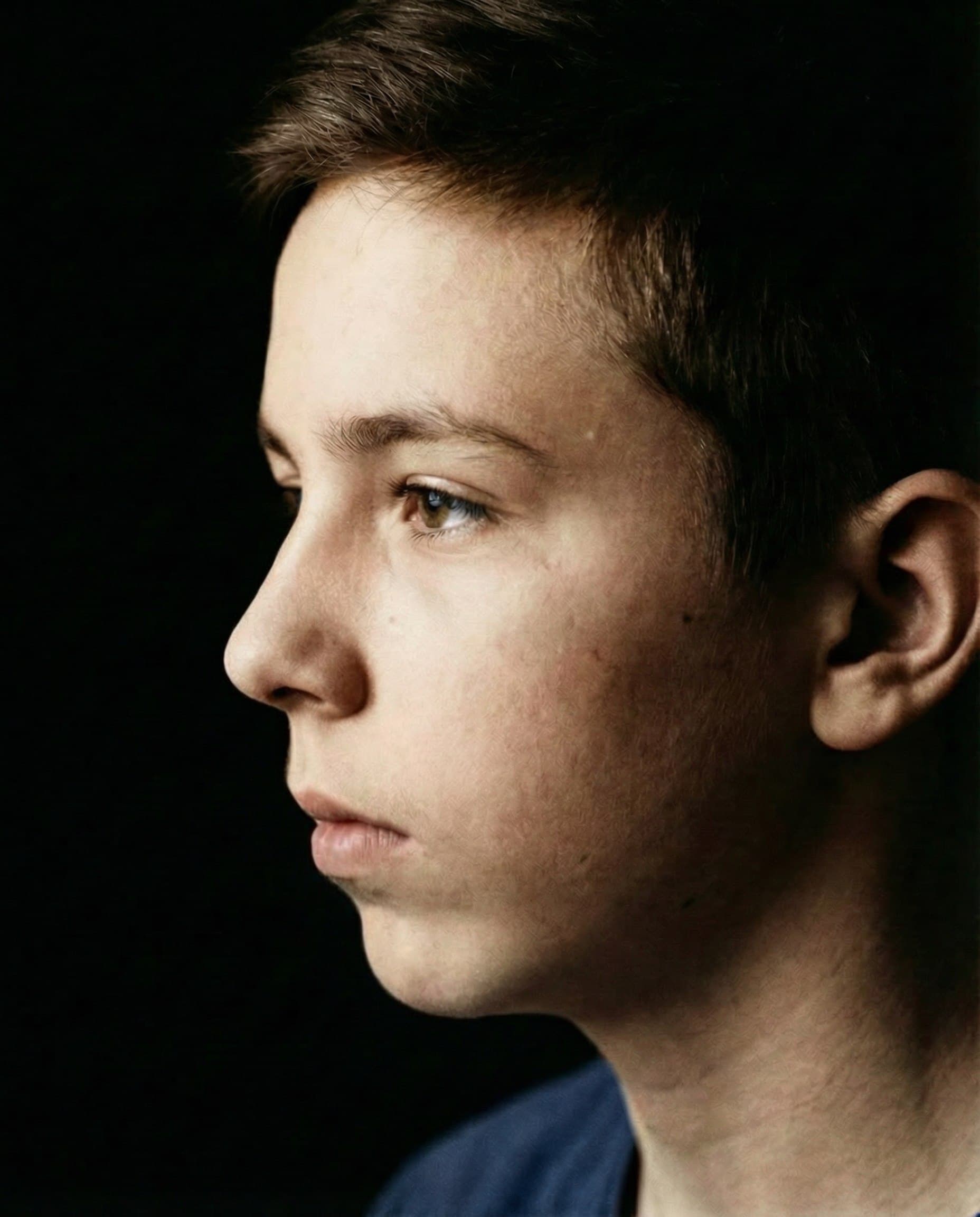 Distal Occlusion Correction after